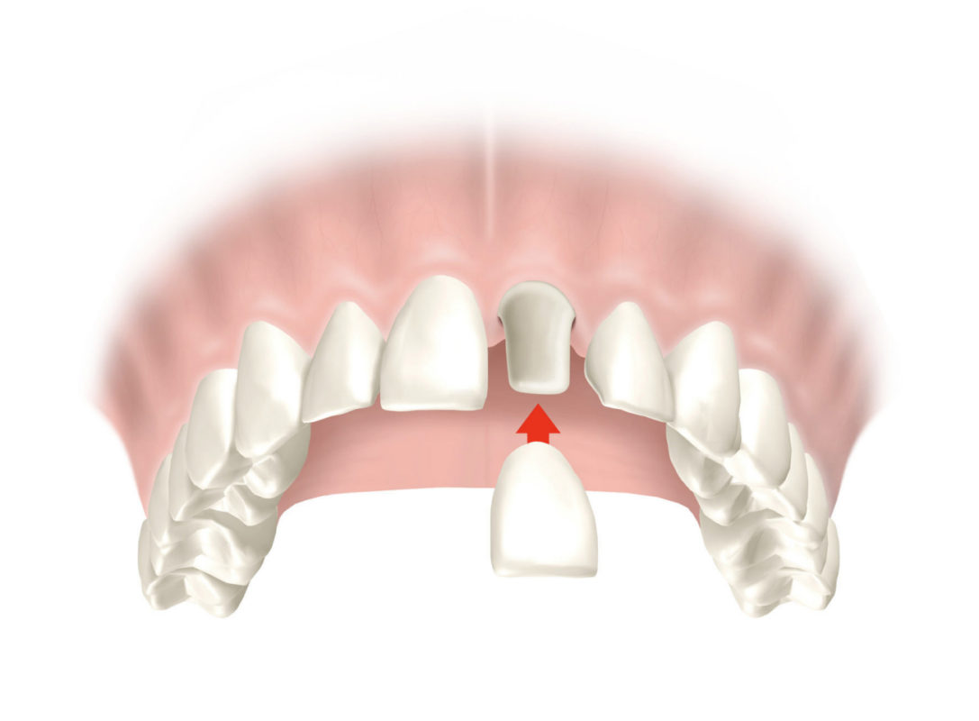 Amalgam (dentistry) - Wikipedia